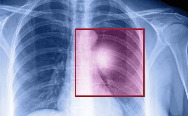 赤外線でがん細胞だけをやっつける画期的治療法を日本人が開発
