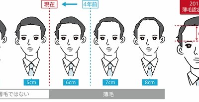 おでこの広さは何cmを越えたら薄毛 30代が最も厳しい判定結果に まぐまぐニュース