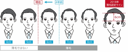 おでこの広さは何cmを越えたら薄毛 30代が最も厳しい判定結果に まぐまぐニュース