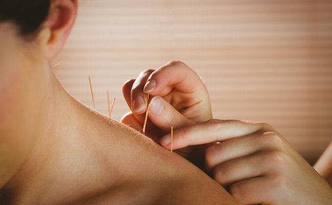 Young,Woman,Getting,Acupuncture,Treatment,In,Therapy,Room