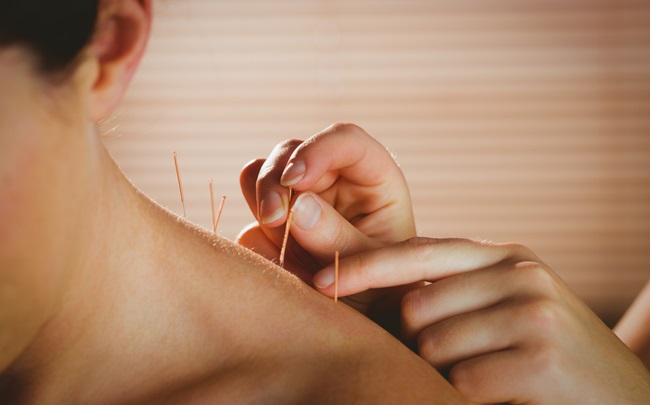 Young,Woman,Getting,Acupuncture,Treatment,In,Therapy,Room