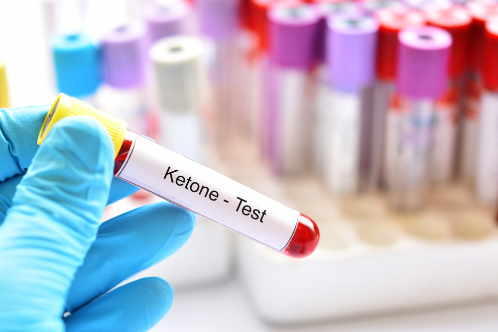 Blood,Sample,Tube,For,Ketone,Test,,Diagnosis,For,Diabetic,Ketoacidosis